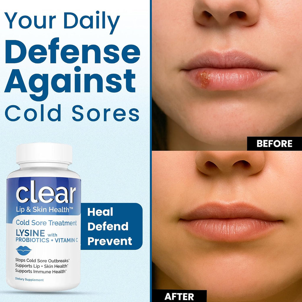 Clear Probiotics Lysine Cold Sore Treatment for Lips – with Lactobacillus Rhamnosus, Acidophilus and Vitamin C – Cold Sore Supplement for Lip & Skin Health, Immune Support & Prevention – 360 Capsules